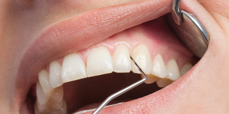 Parodontitistherapie von adentes Zahnärzte aus St. Augustin
