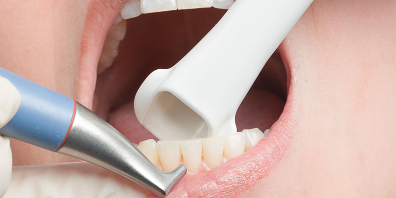 Zahn-Chirugie von den adentes Zahnärzten aus St. Augustin