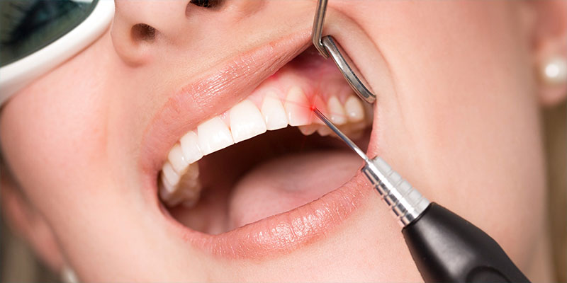Laserbehandlung bei adentes Zahnärzte in Sankt Augustin