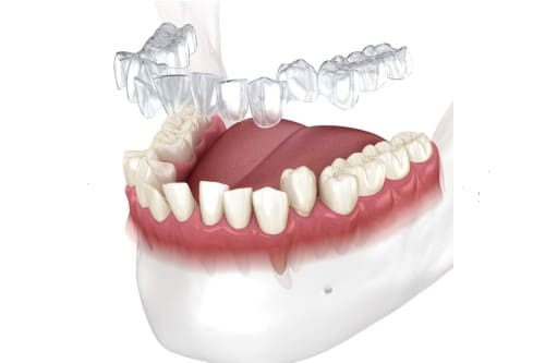 Invisalign Sankt Augustin