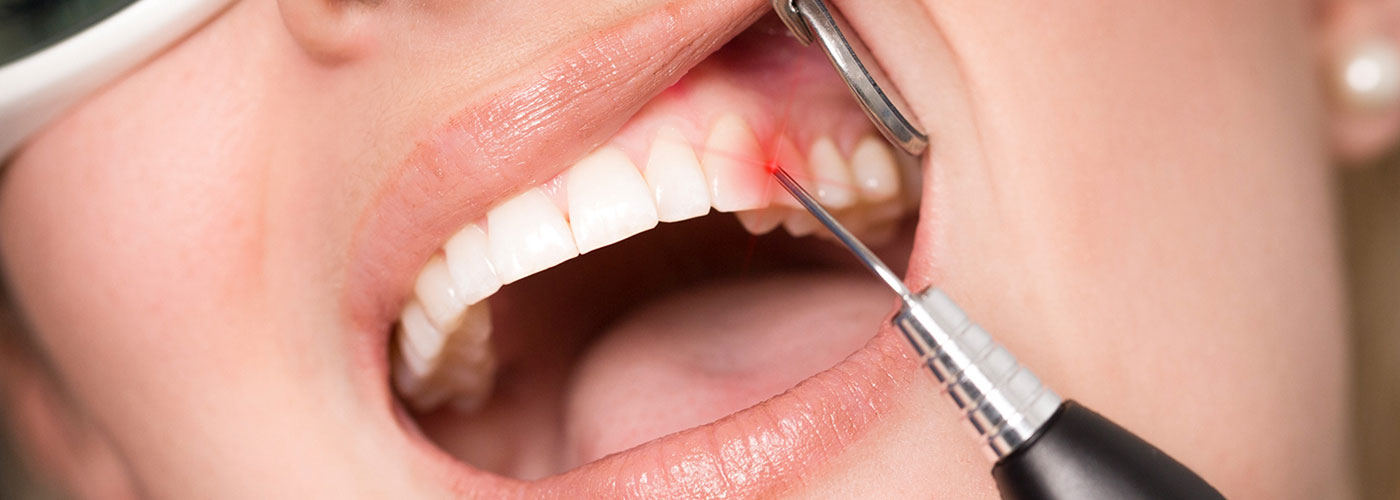Laserbehandlung bei adentes Zahnärzte