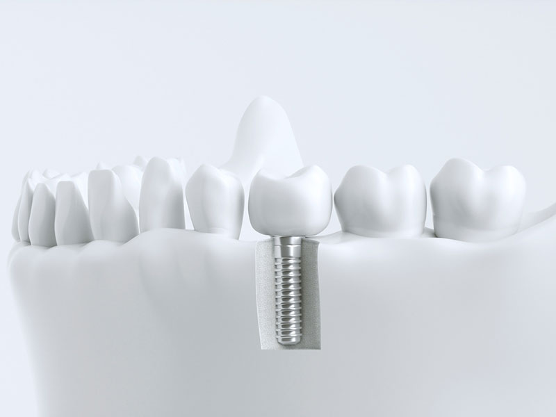 Modell von Zahnkronen, Teilkronen und Brücken